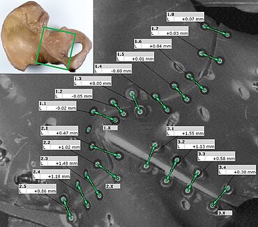 Medição óptica de lacunas de fratura em um modelo de osso pélvico